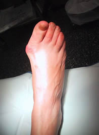 Bunion Treatment in Essex